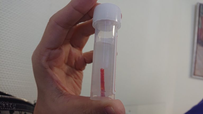 【台勞人生插曲】基本健檢後意外確診急性骨髓白血病